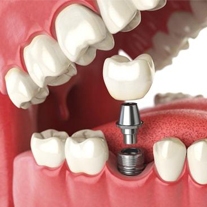  CẤY GHÉP IMPLANT